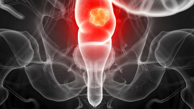 Colorectal Cancer Overview and Indications