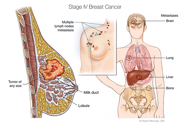 Breast Cancer what you Need to Know