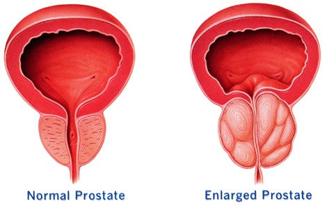 Prostate cancer