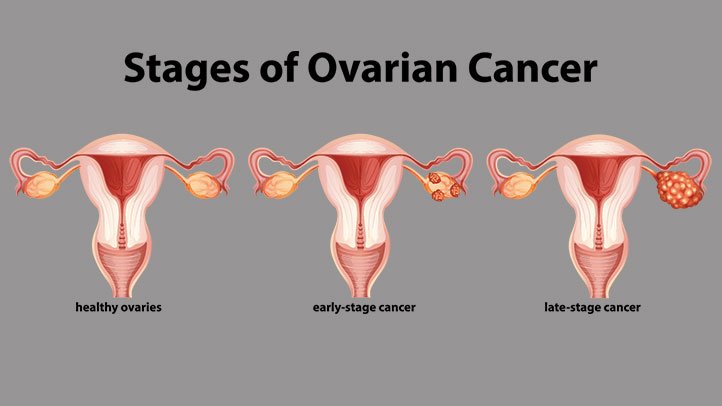 Tacking Ovarian cancer