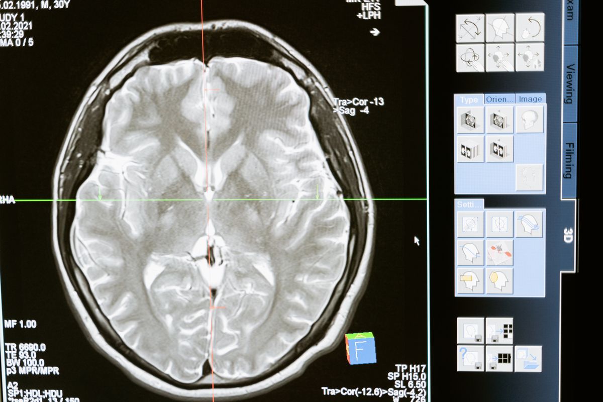 All You Need to Know About Brain Cancer